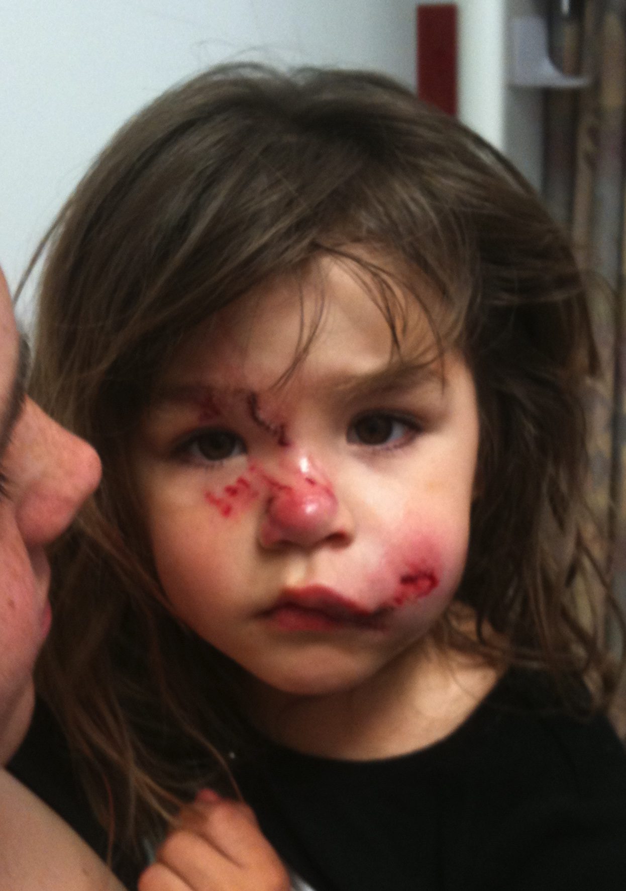 dog bite injury 3 ways to reduce childhood injuries article